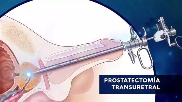 Comprar Prostaktiv en Madrid – El mejor tratamiento para la prostatectomía | Productos naturales para la salud de la próstata