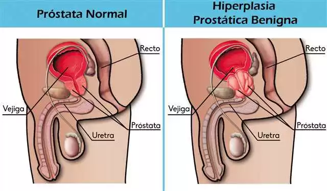 Prevención De La Hipertrofia De Próstata