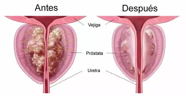 Prostaktiv en Vigo: La solución natural para problemas de próstata