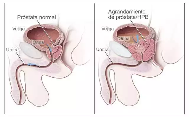 Prostamin en Zaragoza: Mejora tu salud prostática de forma natural